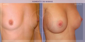 Before and after pictures of a breast augmentation procedure